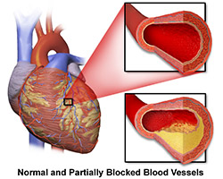 Coronary-artery-anatomy