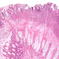 Colitis with C. diff