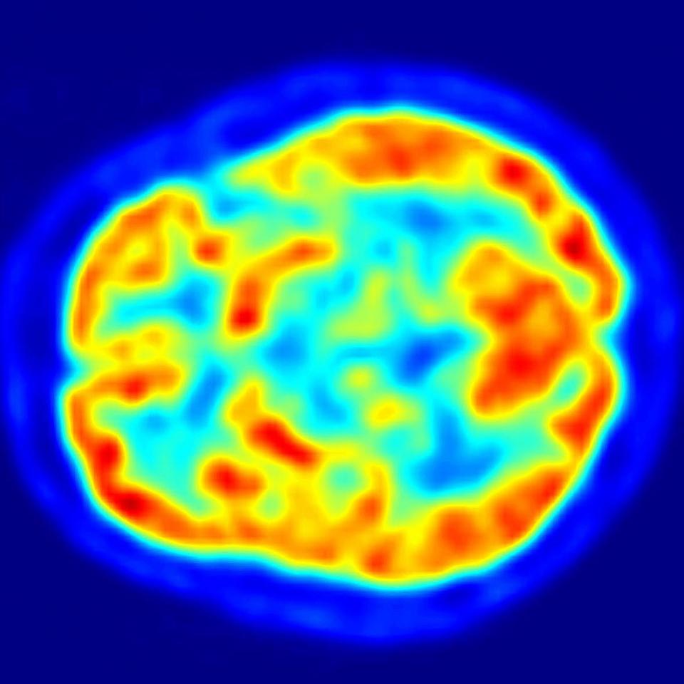 Brain scan created with molecular imaging