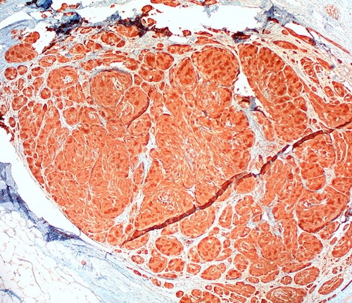 Granular cell tumor