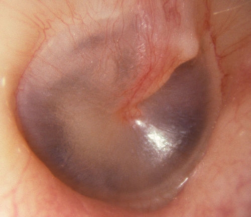 ear drum